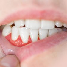 What Is the Role of Nutrition in Preventing Gum Disease?