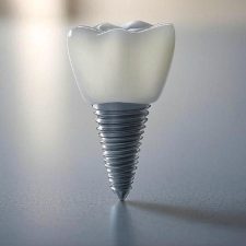 5 Reasons Why Dental Implants Are the Most Natural Solution