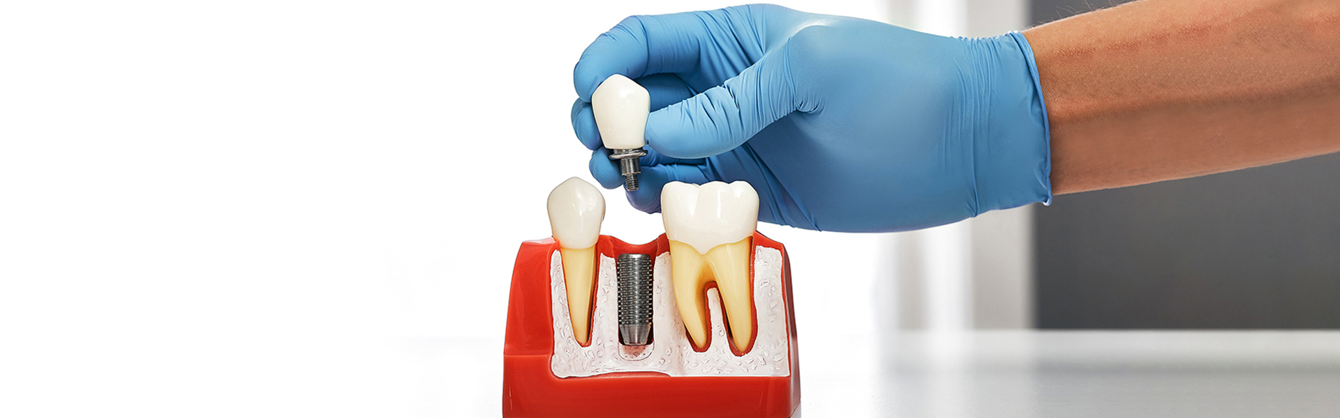 Getting Dental Implants Years Later: Is It Still Possible?