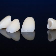 Dental Crown Fell Off Suddenly? How to Handle It